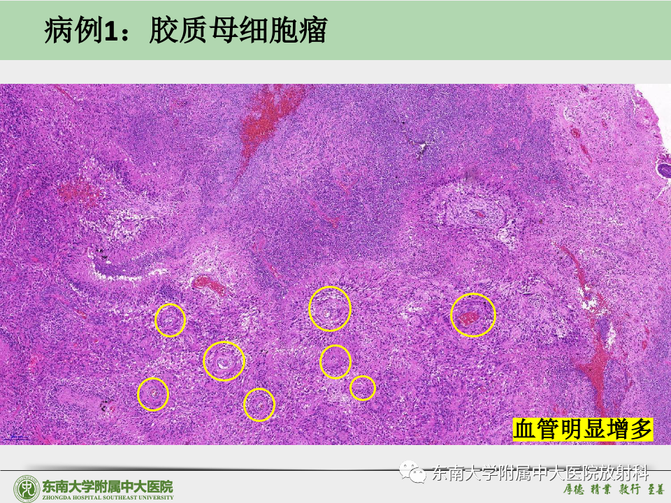 影像PPT - 【病例】胶质母细胞瘤 VS 原发性中枢神经系统淋巴瘤-29 影像PPT - 【病例】胶质母细胞瘤 VS 原发性中枢神经系统淋巴瘤-29
