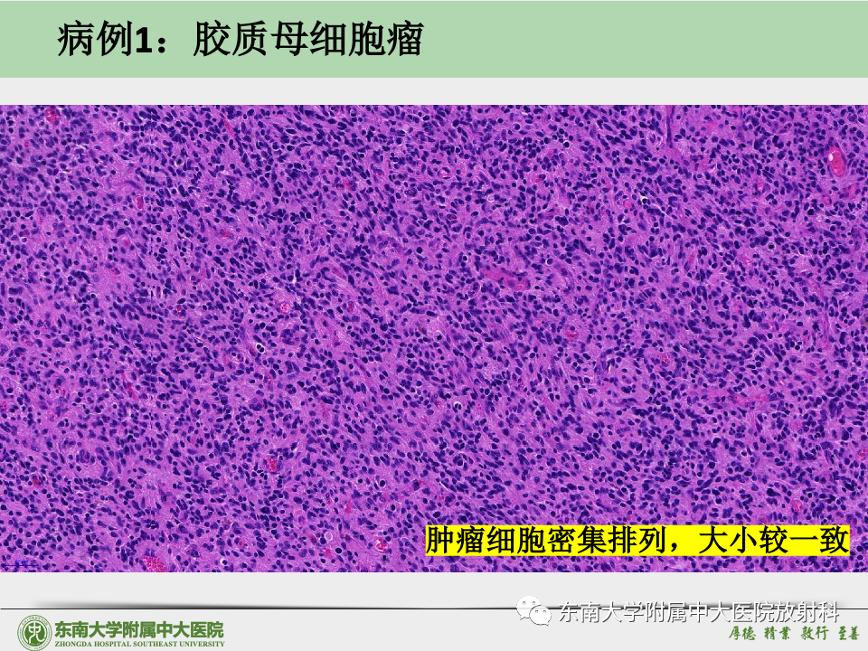 影像PPT - 【病例】胶质母细胞瘤 VS 原发性中枢神经系统淋巴瘤-31 影像PPT - 【病例】胶质母细胞瘤 VS 原发性中枢神经系统淋巴瘤-31