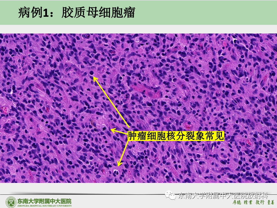 影像PPT - 【病例】胶质母细胞瘤 VS 原发性中枢神经系统淋巴瘤-32 影像PPT - 【病例】胶质母细胞瘤 VS 原发性中枢神经系统淋巴瘤-32