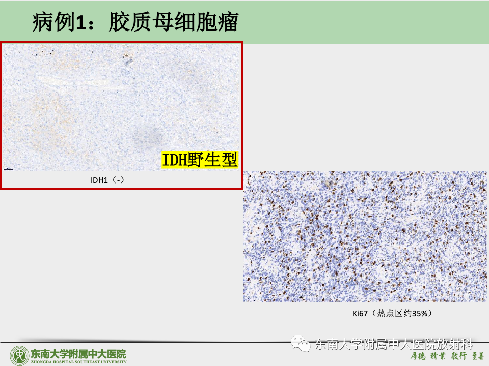 影像PPT - 【病例】胶质母细胞瘤 VS 原发性中枢神经系统淋巴瘤-33 影像PPT - 【病例】胶质母细胞瘤 VS 原发性中枢神经系统淋巴瘤-33