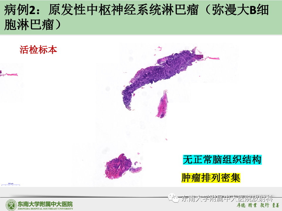 影像PPT - 【病例】胶质母细胞瘤 VS 原发性中枢神经系统淋巴瘤-39 影像PPT - 【病例】胶质母细胞瘤 VS 原发性中枢神经系统淋巴瘤-39