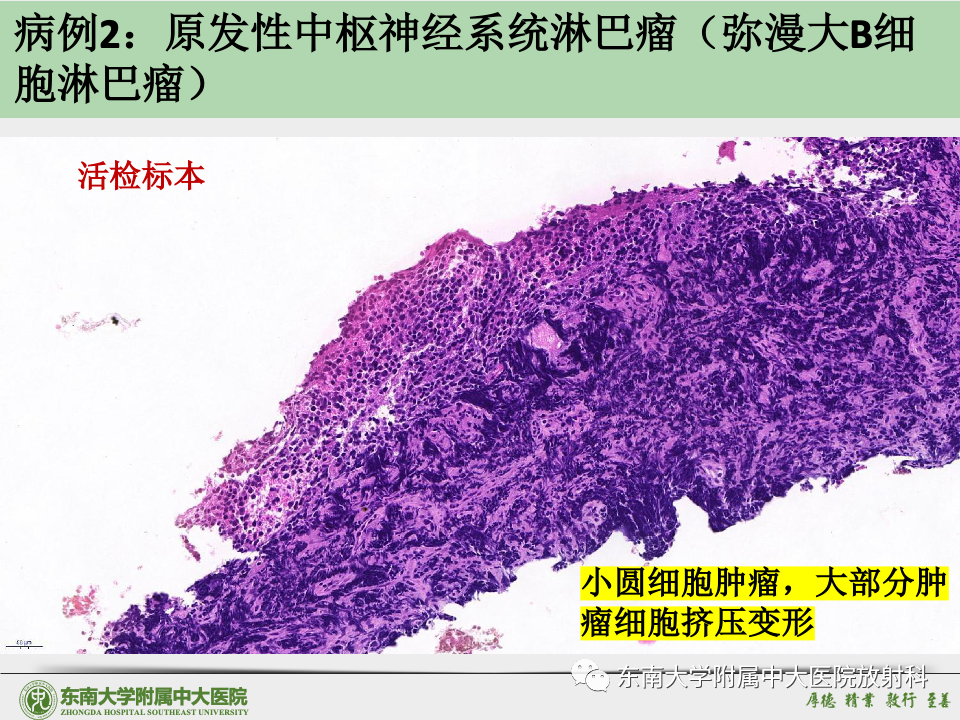 影像PPT - 【病例】胶质母细胞瘤 VS 原发性中枢神经系统淋巴瘤-40 影像PPT - 【病例】胶质母细胞瘤 VS 原发性中枢神经系统淋巴瘤-40