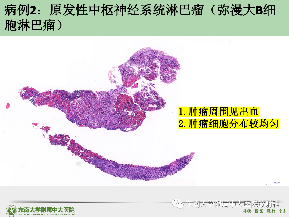 影像PPT - 【病例】胶质母细胞瘤 VS 原发性中枢神经系统淋巴瘤-41 影像PPT - 【病例】胶质母细胞瘤 VS 原发性中枢神经系统淋巴瘤-41
