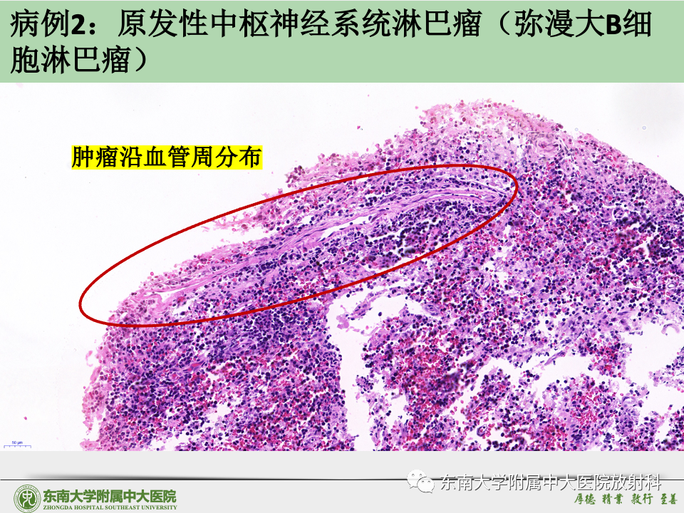 影像PPT - 【病例】胶质母细胞瘤 VS 原发性中枢神经系统淋巴瘤-43 影像PPT - 【病例】胶质母细胞瘤 VS 原发性中枢神经系统淋巴瘤-43