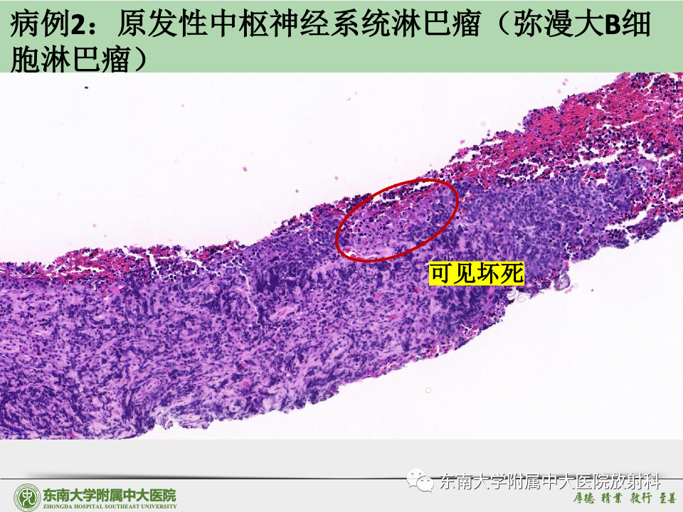 影像PPT - 【病例】胶质母细胞瘤 VS 原发性中枢神经系统淋巴瘤-42 影像PPT - 【病例】胶质母细胞瘤 VS 原发性中枢神经系统淋巴瘤-42