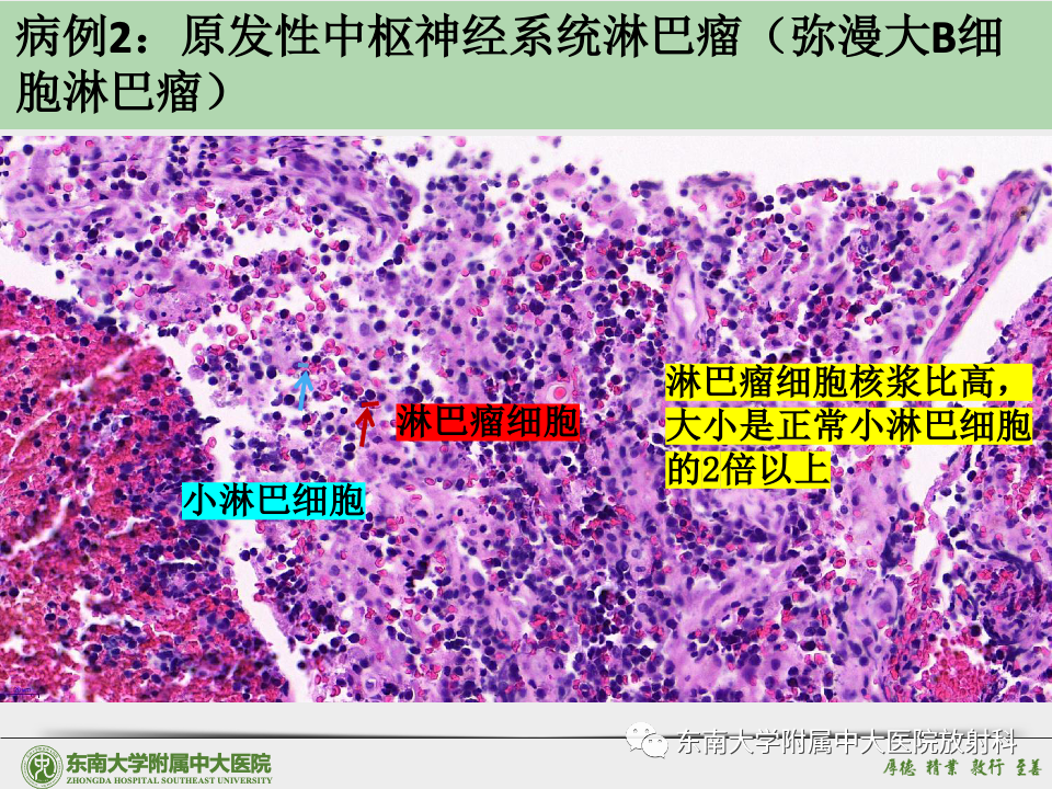 影像PPT - 【病例】胶质母细胞瘤 VS 原发性中枢神经系统淋巴瘤-44 影像PPT - 【病例】胶质母细胞瘤 VS 原发性中枢神经系统淋巴瘤-44