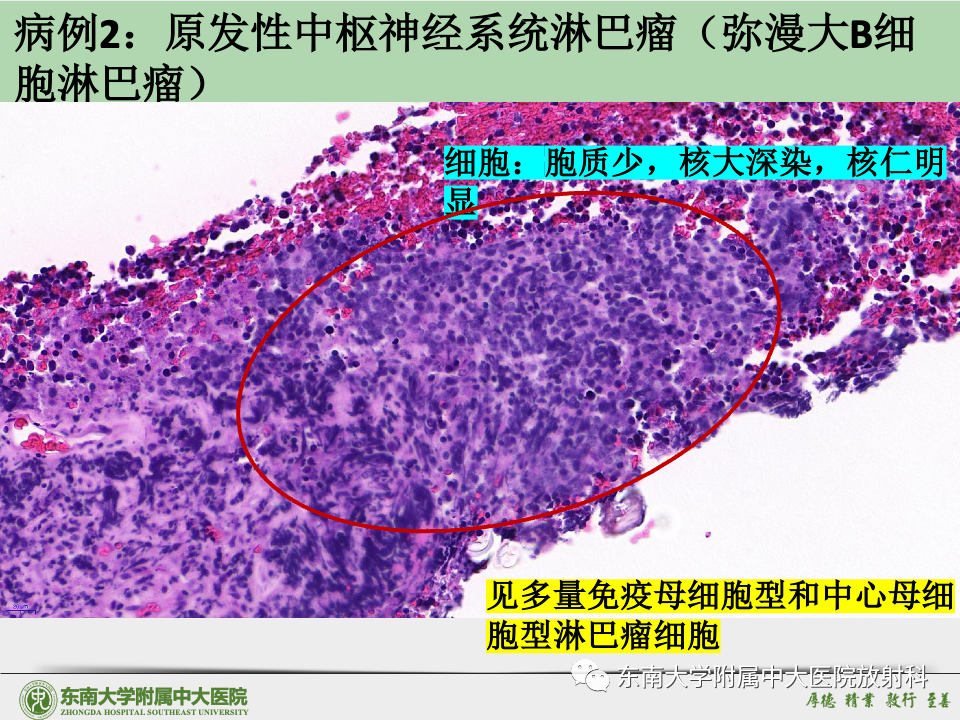 影像PPT - 【病例】胶质母细胞瘤 VS 原发性中枢神经系统淋巴瘤-45 影像PPT - 【病例】胶质母细胞瘤 VS 原发性中枢神经系统淋巴瘤-45