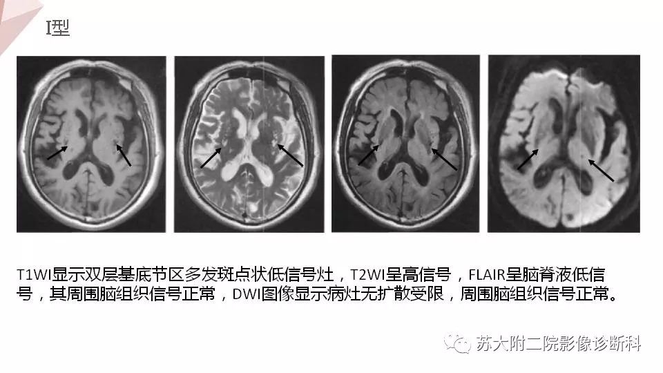 影像PPT - 【PPT】血管周围间隙的MRI表现-11