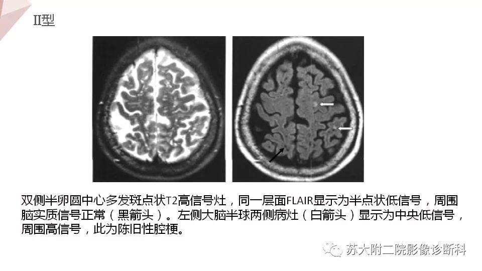 影像PPT - 【PPT】血管周围间隙的MRI表现-12