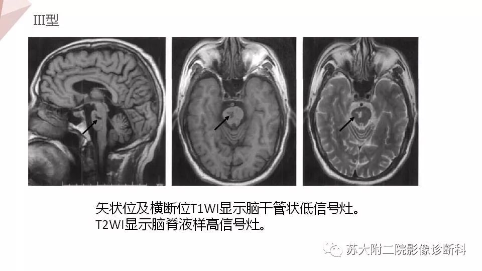 影像PPT - 【PPT】血管周围间隙的MRI表现-13