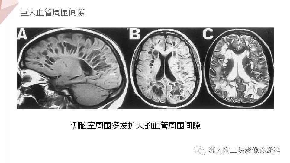 影像PPT - 【PPT】血管周围间隙的MRI表现-15