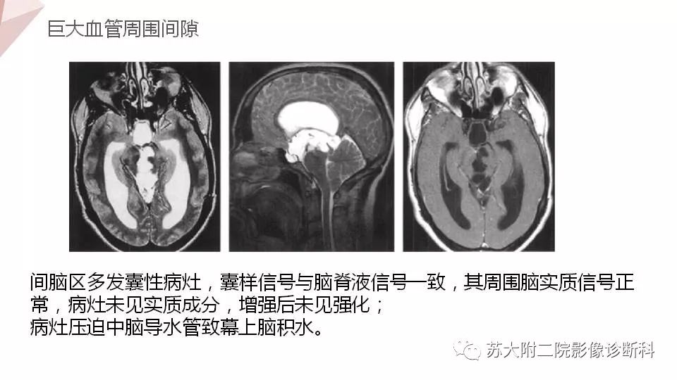 影像PPT - 【PPT】血管周围间隙的MRI表现-16