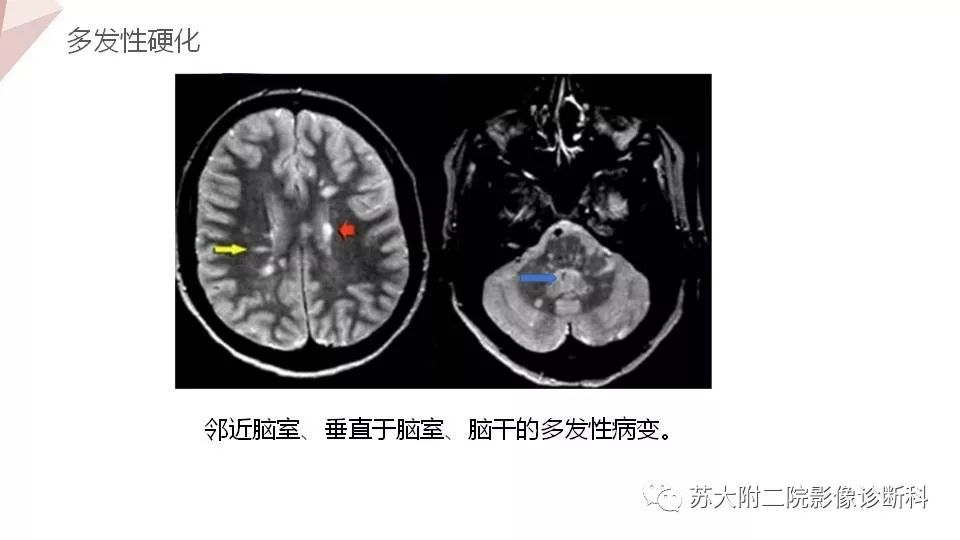 影像PPT - 【PPT】血管周围间隙的MRI表现-22
