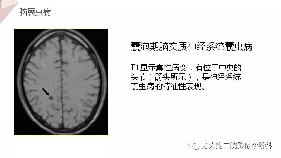 影像PPT - 【PPT】血管周围间隙的MRI表现-24