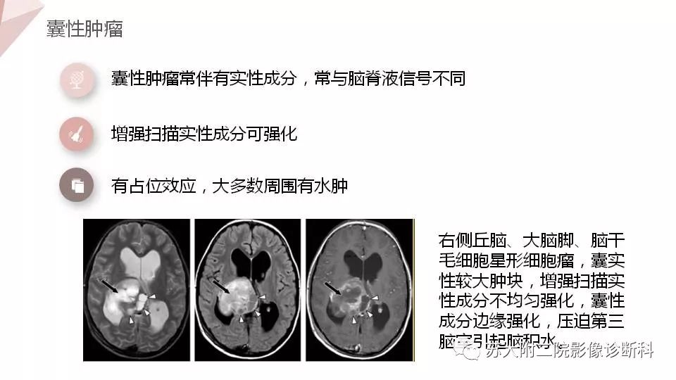 影像PPT - 【PPT】血管周围间隙的MRI表现-25