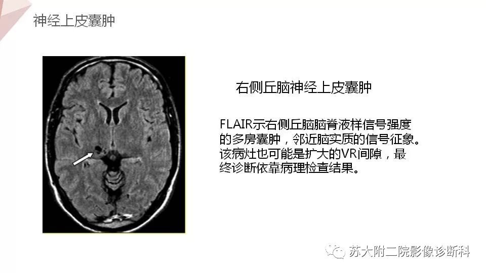 影像PPT - 【PPT】血管周围间隙的MRI表现-28