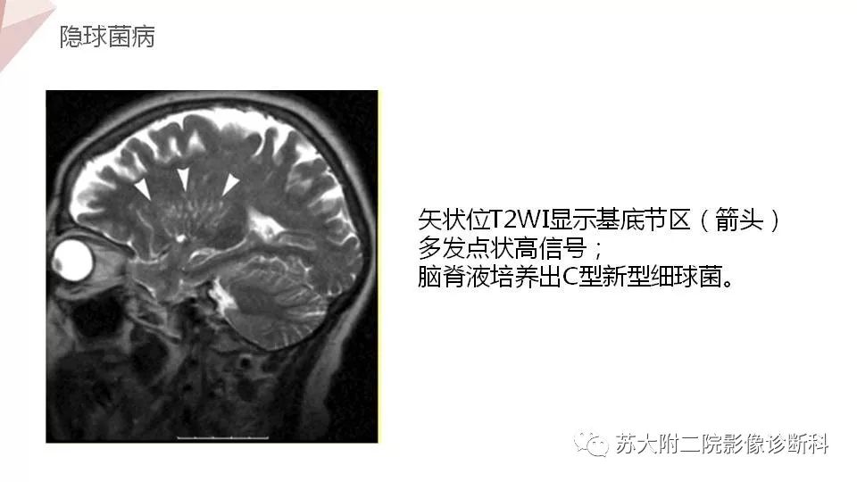 影像PPT - 【PPT】血管周围间隙的MRI表现-30