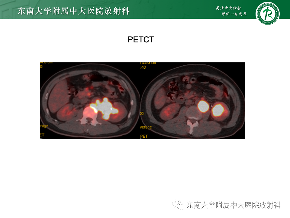 影像PPT - 【PPT】肾脏淋巴瘤-5