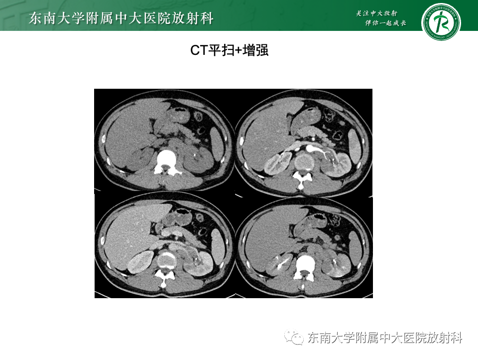 影像PPT - 【PPT】肾脏淋巴瘤-4