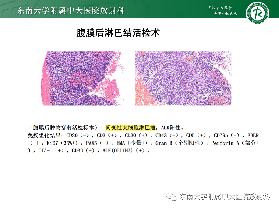 影像PPT - 【PPT】肾脏淋巴瘤-6