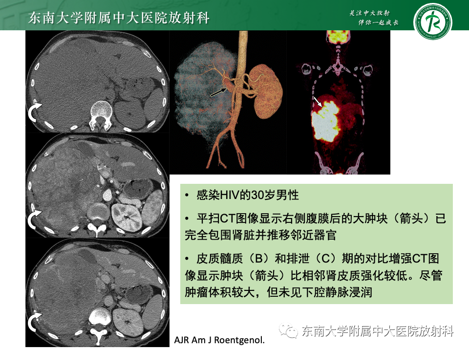 影像PPT - 【PPT】肾脏淋巴瘤-19