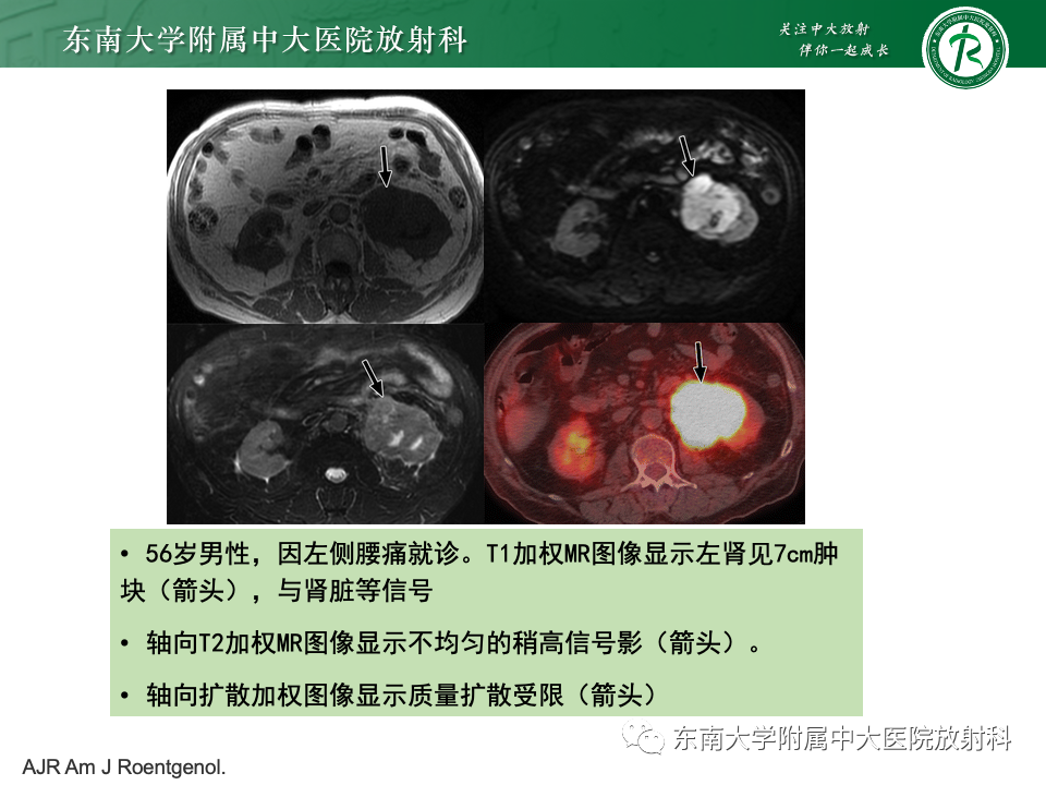 影像PPT - 【PPT】肾脏淋巴瘤-20