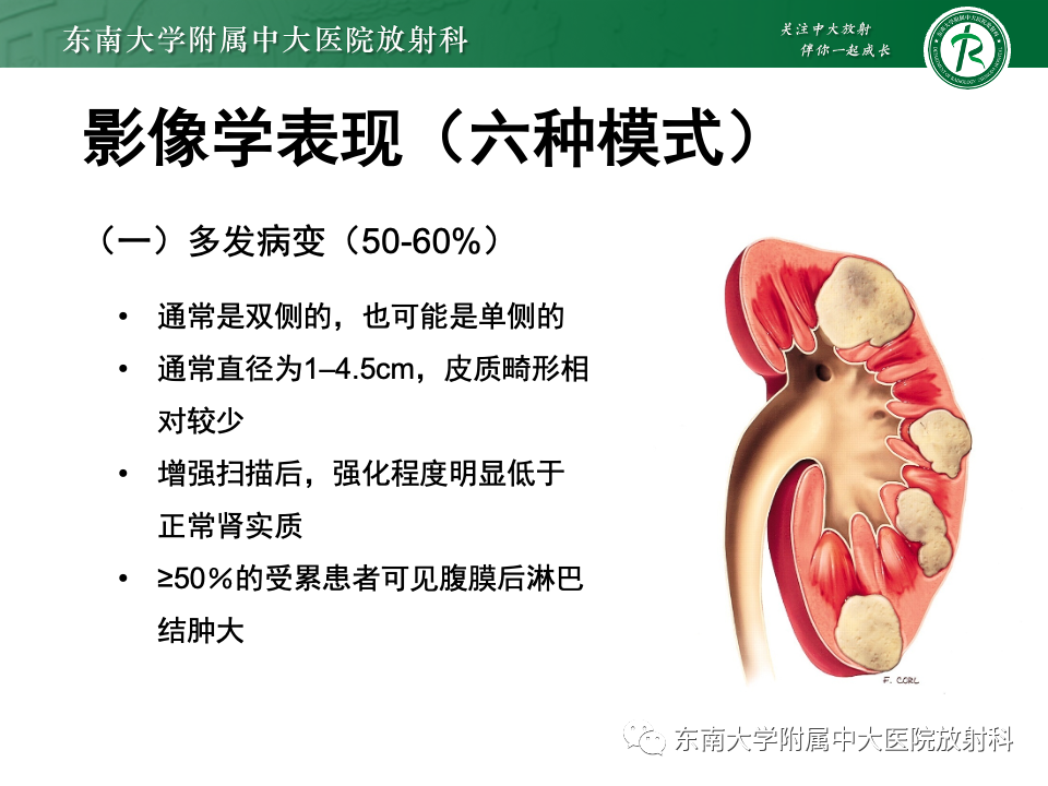影像PPT - 【PPT】肾脏淋巴瘤-21