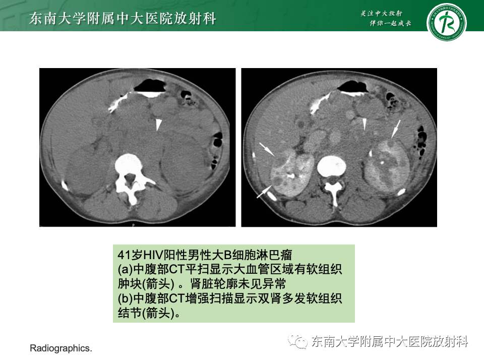 影像PPT - 【PPT】肾脏淋巴瘤-22
