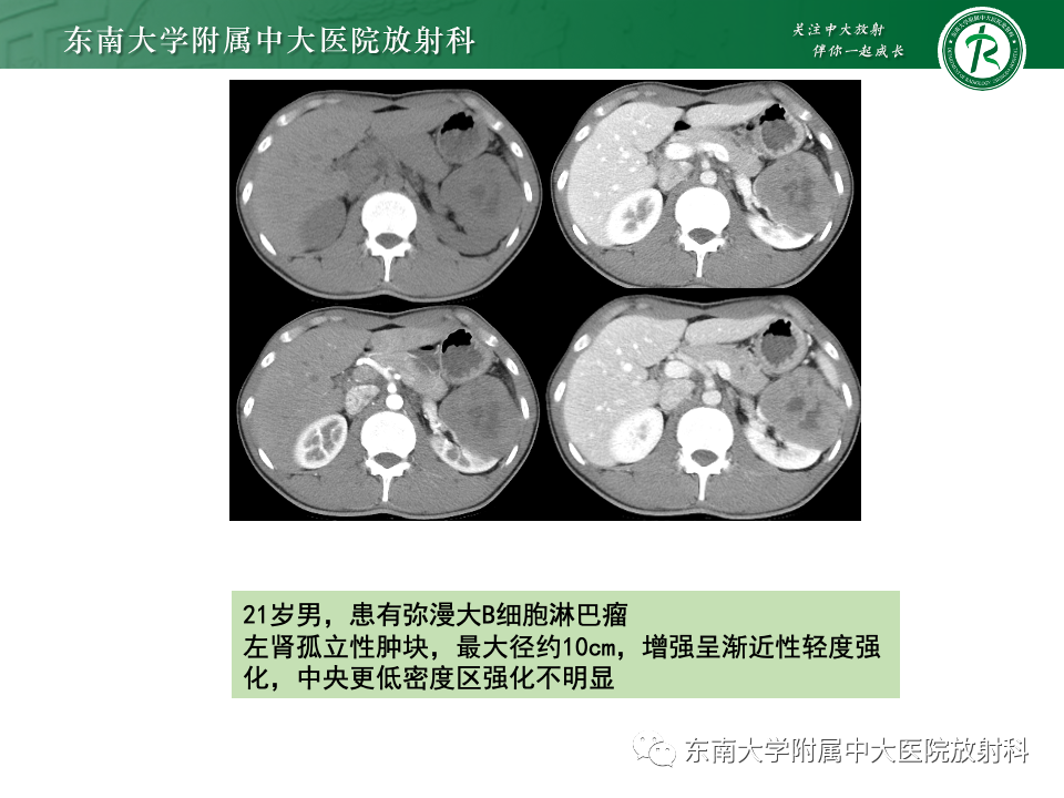 影像PPT - 【PPT】肾脏淋巴瘤-24