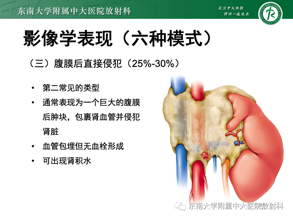 影像PPT - 【PPT】肾脏淋巴瘤-25