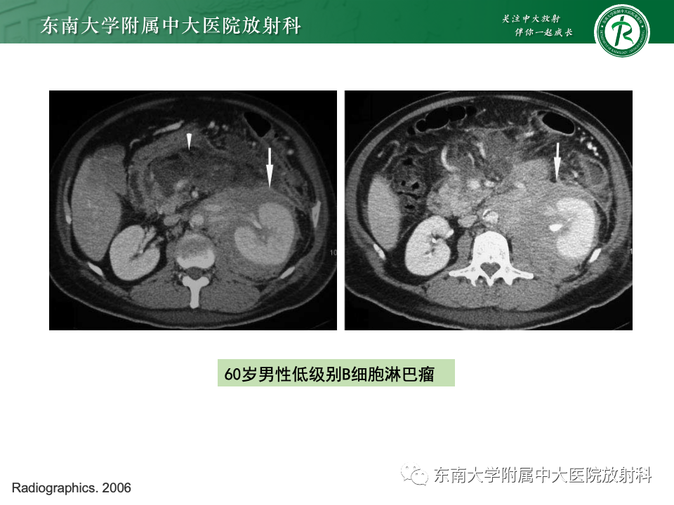 影像PPT - 【PPT】肾脏淋巴瘤-26