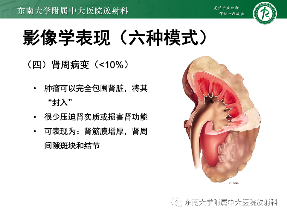 影像PPT - 【PPT】肾脏淋巴瘤-27