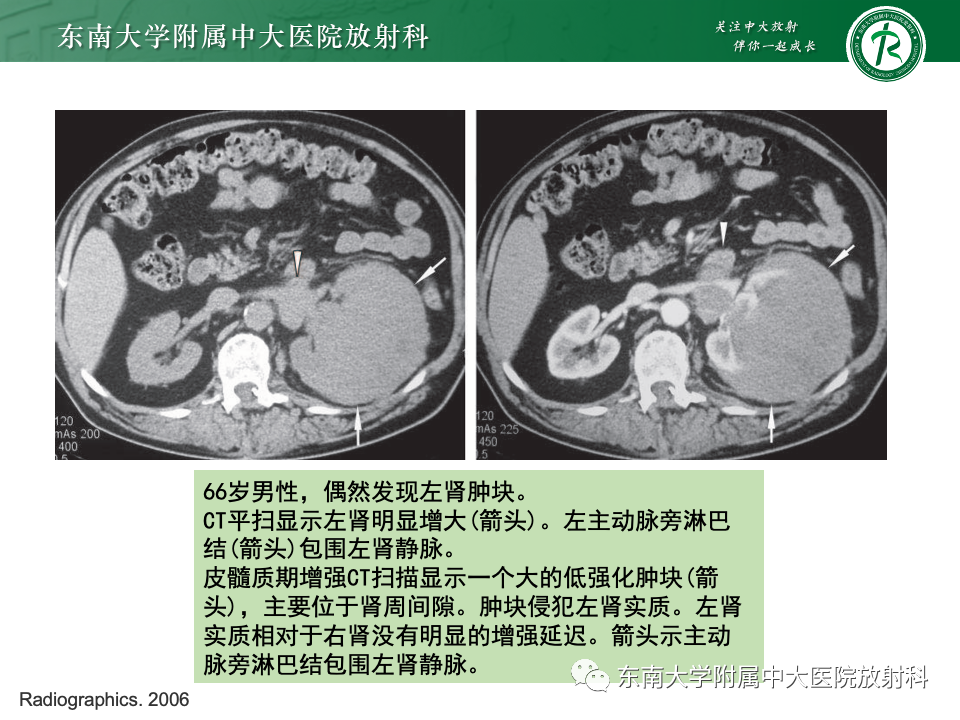 影像PPT - 【PPT】肾脏淋巴瘤-28
