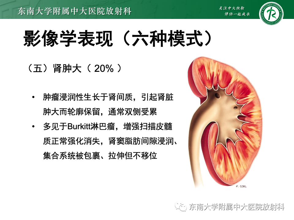 影像PPT - 【PPT】肾脏淋巴瘤-29