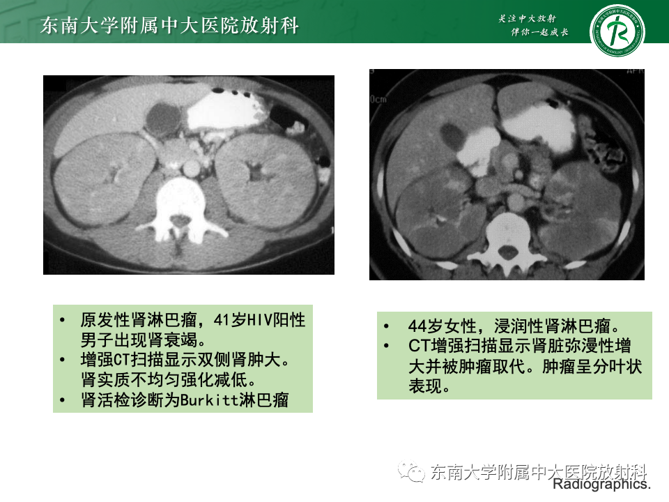 影像PPT - 【PPT】肾脏淋巴瘤-30