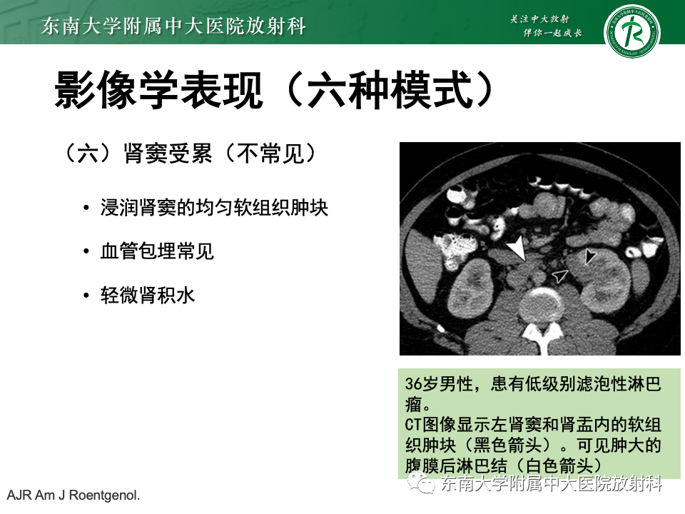 影像PPT - 【PPT】肾脏淋巴瘤-31