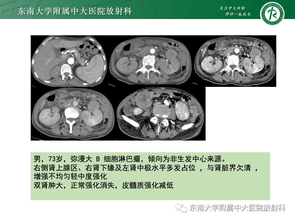 影像PPT - 【PPT】肾脏淋巴瘤-32