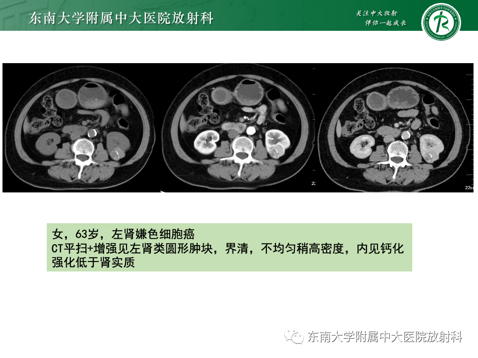 影像PPT - 【PPT】肾脏淋巴瘤-35