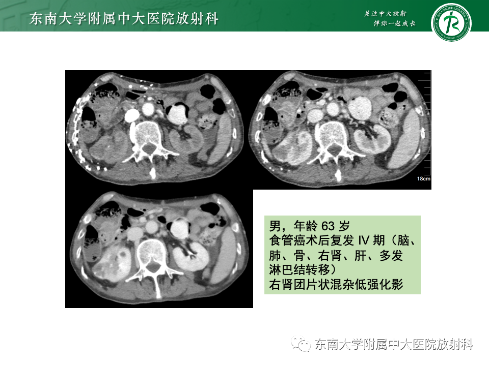 影像PPT - 【PPT】肾脏淋巴瘤-37