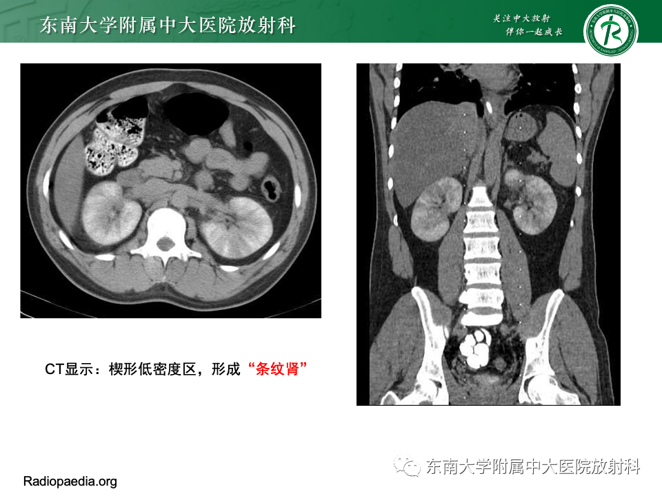 影像PPT - 【PPT】肾脏淋巴瘤-39