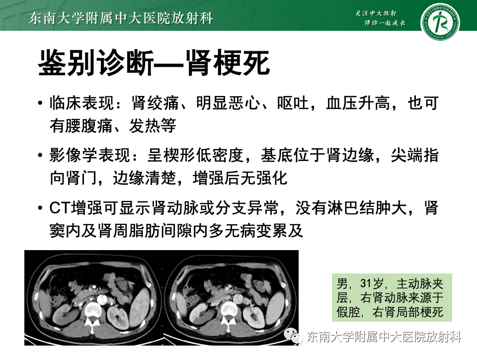 影像PPT - 【PPT】肾脏淋巴瘤-40
