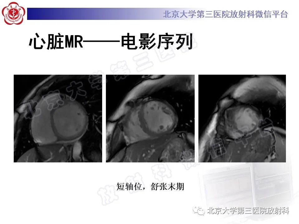影像PPT - 【PPT】系统性硬化病心脏受累相关表现-5