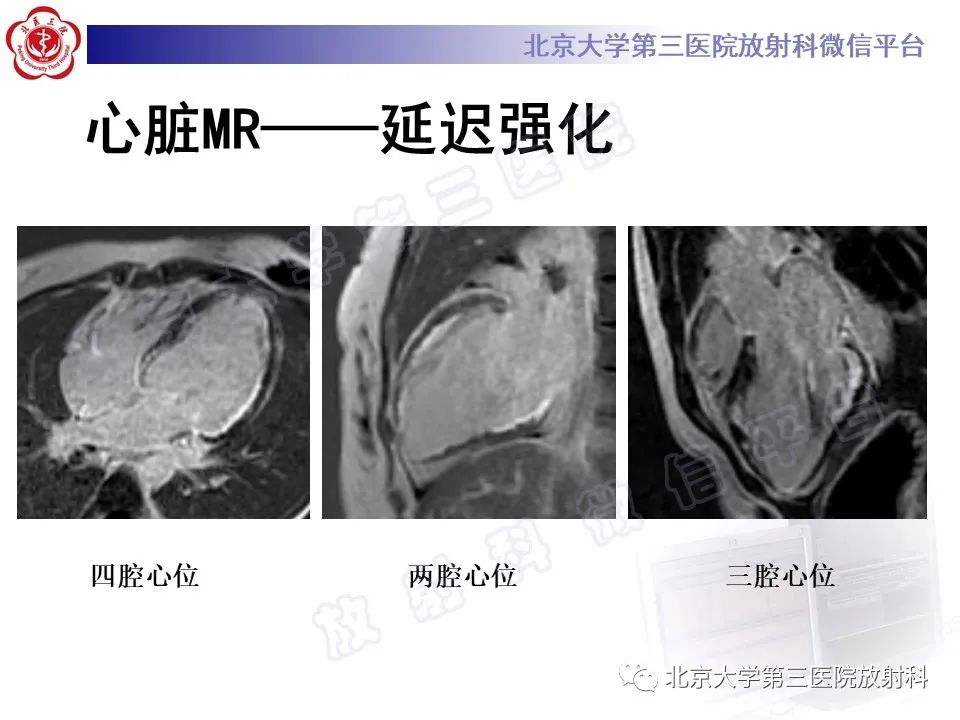 影像PPT - 【PPT】系统性硬化病心脏受累相关表现-6