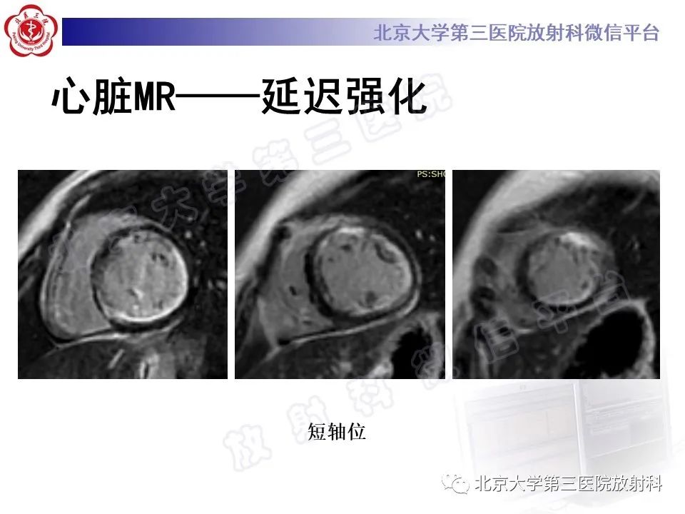 影像PPT - 【PPT】系统性硬化病心脏受累相关表现-7