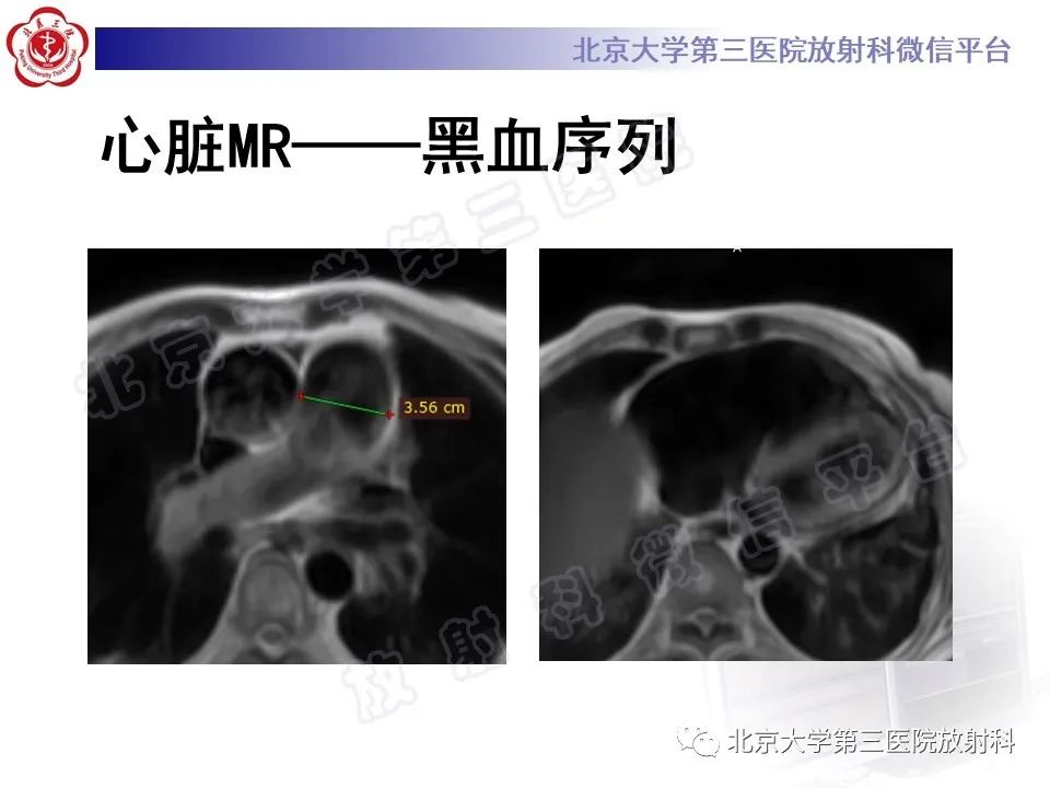影像PPT - 【PPT】系统性硬化病心脏受累相关表现-10