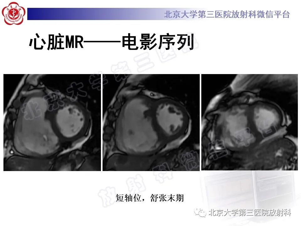 影像PPT - 【PPT】系统性硬化病心脏受累相关表现-12