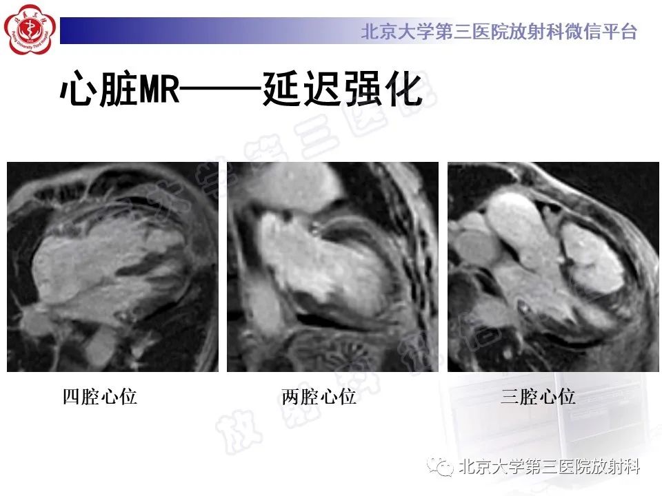 影像PPT - 【PPT】系统性硬化病心脏受累相关表现-13