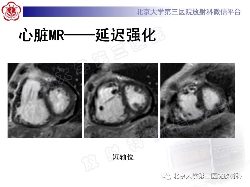 影像PPT - 【PPT】系统性硬化病心脏受累相关表现-14