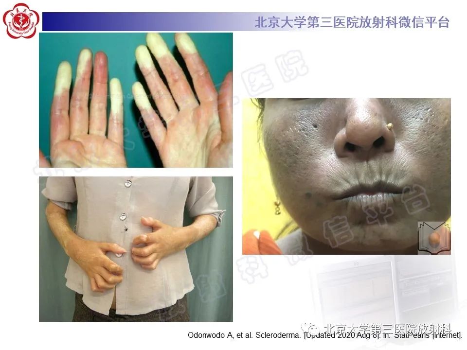 影像PPT - 【PPT】系统性硬化病心脏受累相关表现-23