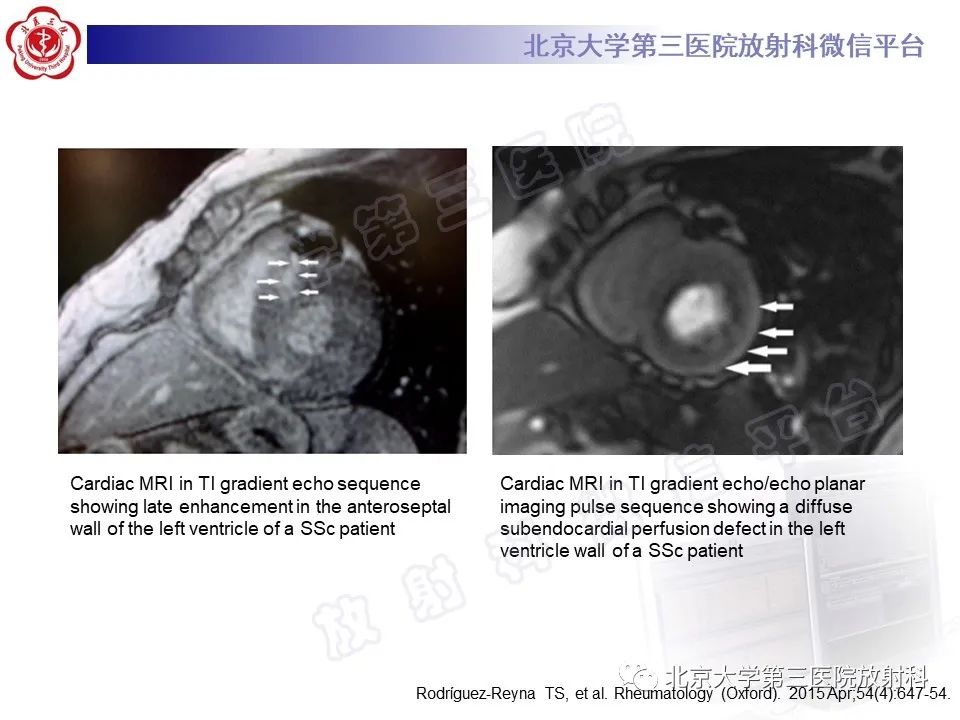 影像PPT - 【PPT】系统性硬化病心脏受累相关表现-29